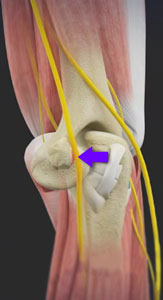 Cubital Tunnel Release