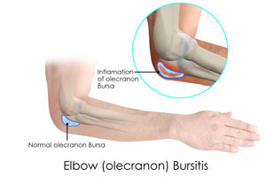 Elbow (Olecranon) Bursitis