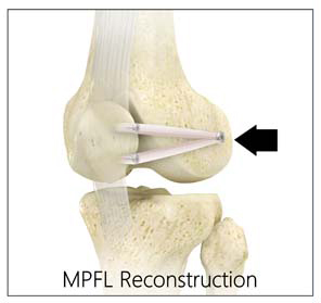 Medial Patellofemoral Ligament Reconstruction