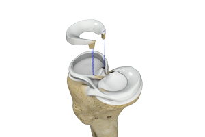 Meniscal Surgery