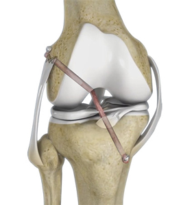 Multiligament Reconstruction of the Knee