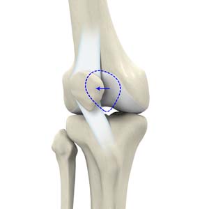 Recurrent Patella Dislocation