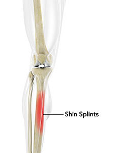 Shin Splints